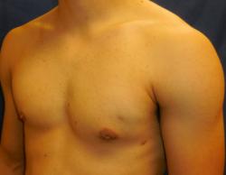 After Results for Gynecomastia