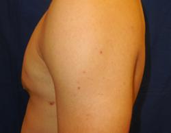 After Results for Gynecomastia