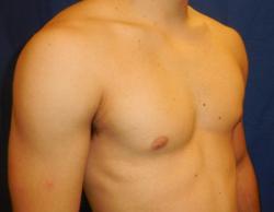 After Results for Gynecomastia