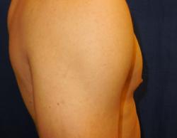 After Results for Gynecomastia