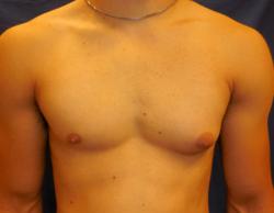 Before Results for Gynecomastia