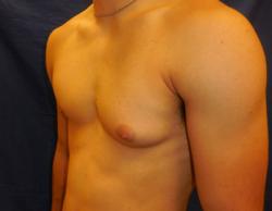 Before Results for Gynecomastia