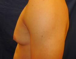 Before Results for Gynecomastia