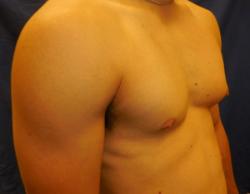 Before Results for Gynecomastia