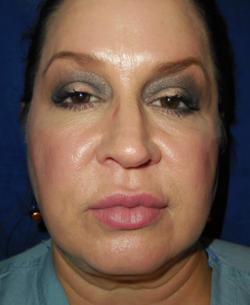 After Results for Botox, Tissue Fillers, Lip Augmentation
