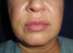 After Results for Neuromodulators (Botox / Dysport), Tissue Fillers, Lip Augmentation