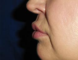 After Results for Lip Augmentation