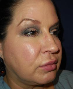 After Results for Lip Augmentation