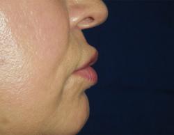 After Results for Lip Augmentation