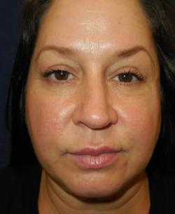 Before Results for Botox, Tissue Fillers, Lip Augmentation