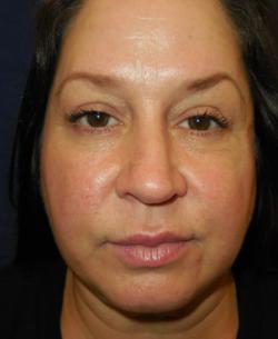 Before Results for Botox