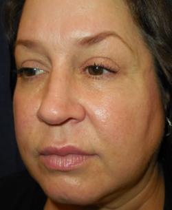 Before Results for Lip Augmentation