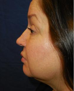 Before Results for Lip Augmentation