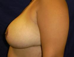 After Results for Breast Reduction