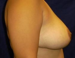 After Results for Breast Reduction