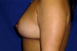After Results for Breast Lift