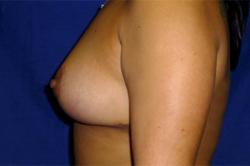 After Results for Breast Lift / Mastopexy