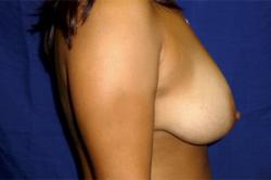 Before Results for Breast Lift