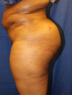 After Results for Gluteal Augmentation