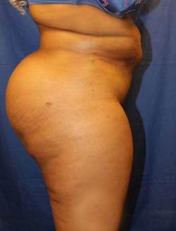 After Results for Gluteal Augmentation