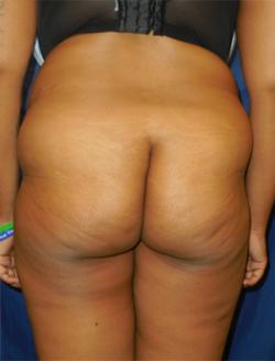 Before Results for Gluteal Augmentation