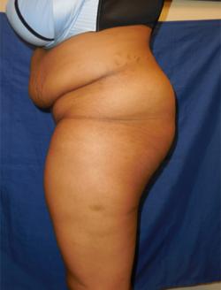 Before Results for Gluteal Augmentation