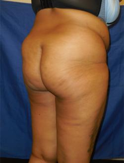 Before Results for Gluteal Augmentation