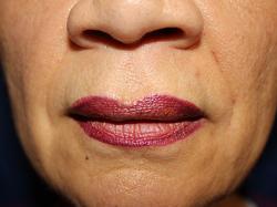 After Results for Tissue Fillers, Lip Augmentation