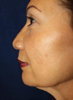 After Results for Lip Augmentation