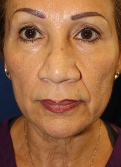 Before Results for Tissue Fillers, Lip Augmentation