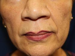 Before Results for Tissue Fillers, Lip Augmentation