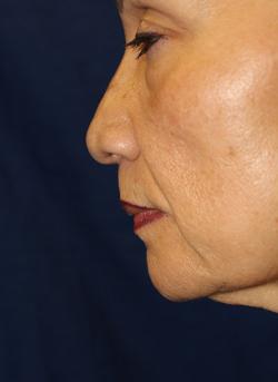 Before Results for Lip Augmentation