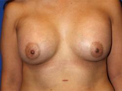 After Results for Breast Augmentation