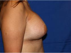 After Results for Breast Augmentation