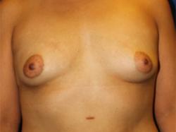 Before Results for Breast Augmentation