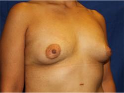 Before Results for Breast Augmentation