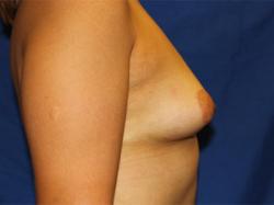 Before Results for Breast Augmentation