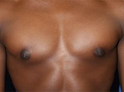 After Results for Gynecomastia