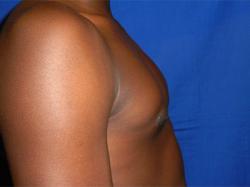 After Results for Gynecomastia