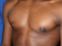 After Results for Gynecomastia