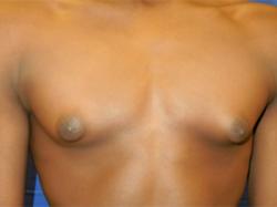 Before Results for Gynecomastia