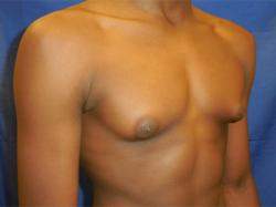 Before Results for Gynecomastia