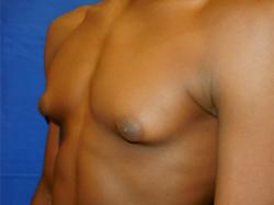 Before Results for Gynecomastia