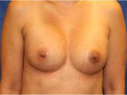 After Results for Breast Augmentation