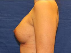 After Results for Breast Augmentation