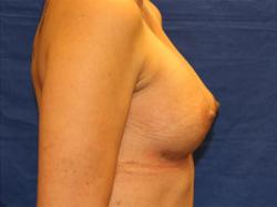 After Results for Breast Augmentation