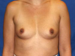 Before Results for Breast Augmentation