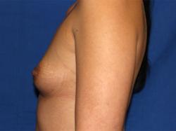 Before Results for Breast Augmentation