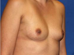 Before Results for Breast Augmentation