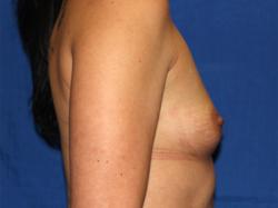 Before Results for Breast Augmentation